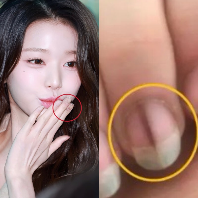 검지 엄지 손톱 검은세로줄 원인 당뇨, 흑색종 때문일까 & 치료방법은?