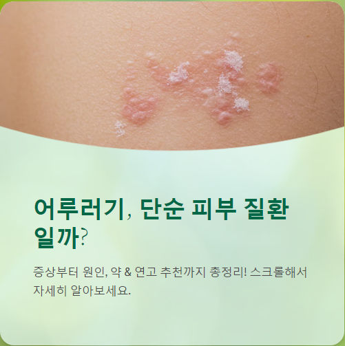  어루러기 증상, 원인, 약 과 연고 추천까지~!