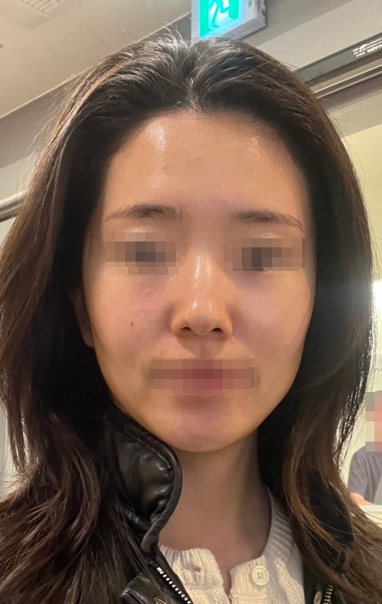  [에토좀PTT+제네시스 레이저] 2차 내돈내산 기록