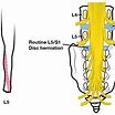 요추 신경근병증(Lumbosacral Radiculopathy)