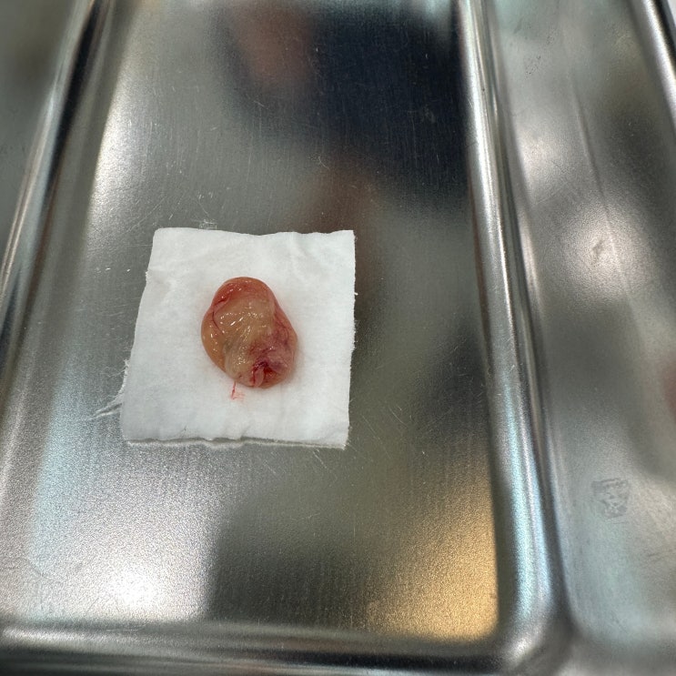  코물혹 수술없이 제거한 후기 사진들을 보면서