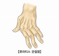 류마티스 관절염(RA)
