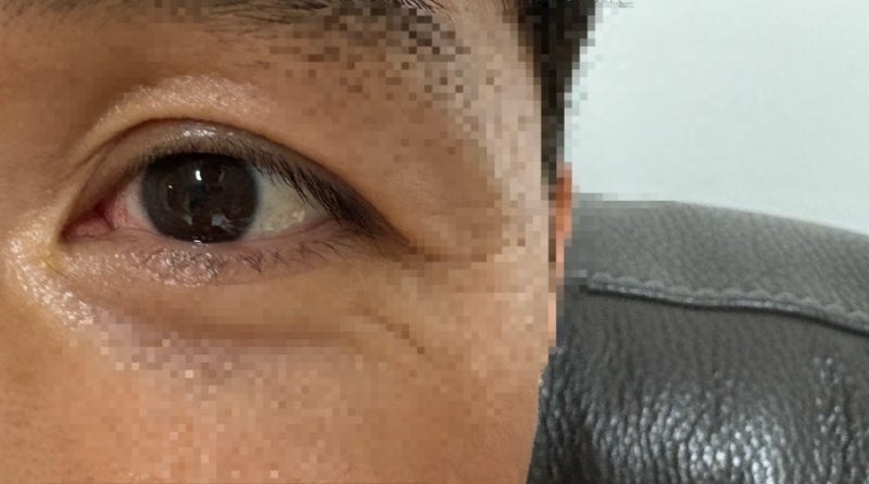 눈 익상편 수술 후기 중앙대병원 김경우 교수님이 유명한 이유?