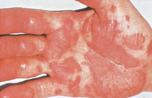 급성 척추관절병-반응성 관절염reactive arthritis
