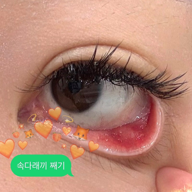 속다래끼 째기 고통 붓기 비용 등 후기 / 원인 / 증상 / 렌즈 언제부터?
