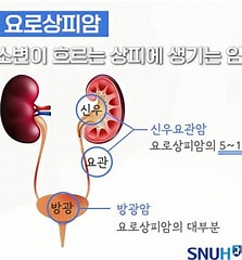  신장/비뇨기계 질환 다섯번째 - 신장 골반암과 요관암