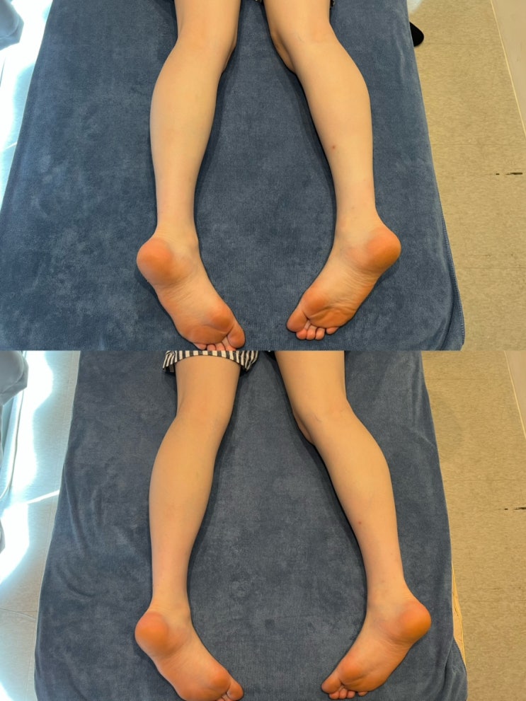  [동래피부관리] 날씬한데도 하체부종 심하다면? 원인과 관리 방법!