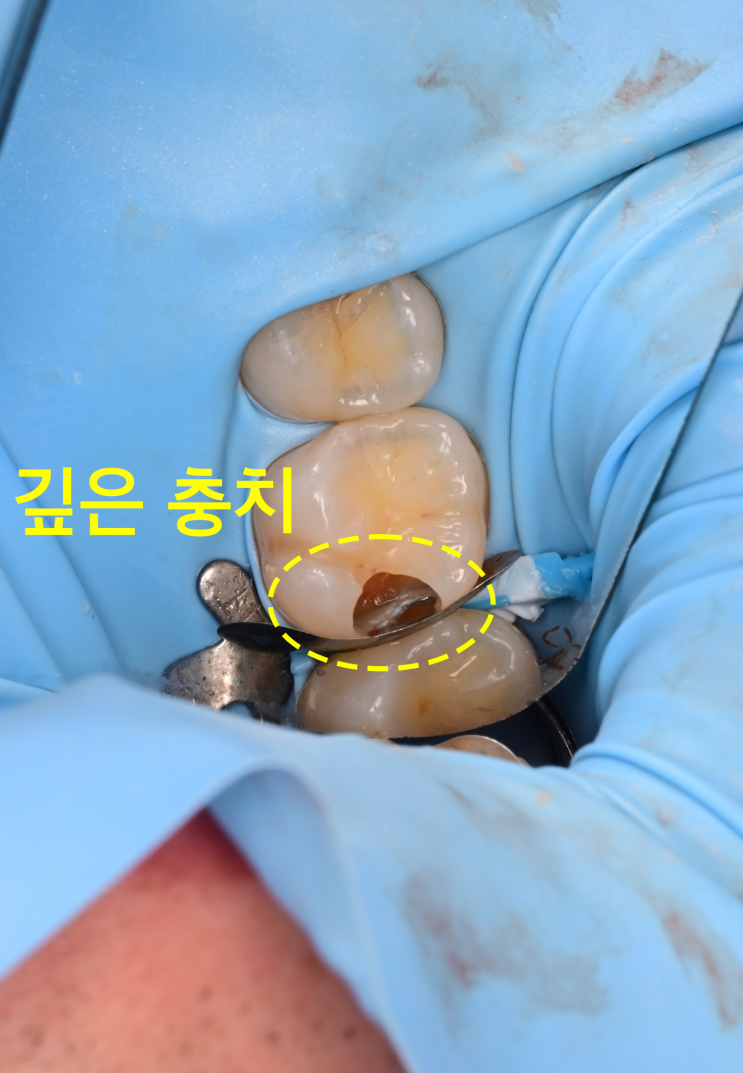  치아 사이 충치, 레진빌드업으로 치료한 케이스