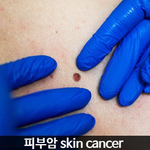 혹시 이 점, 위험한 걸까? 피부암 전조증상 체크리스트 정리