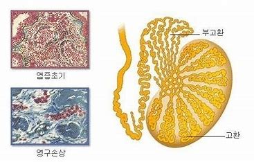 신장/비뇨기계 질환 여섯번째 고환암에 대해