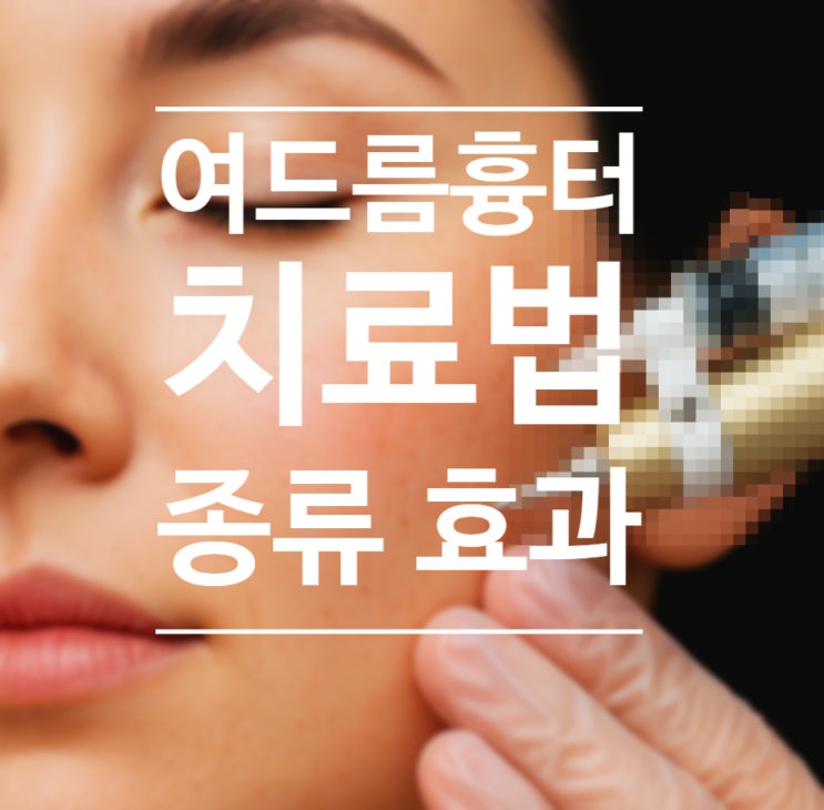  여드름흉터, 프락셀만으로 효과 없는 이유. 패인흉터치료 잘하는 아르네의원