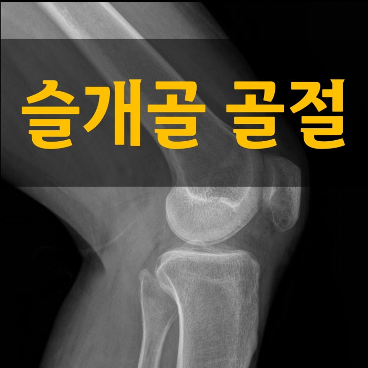  무릎뼈 슬개골 골절 회복, 뼈에 좋은 식단과 한약?