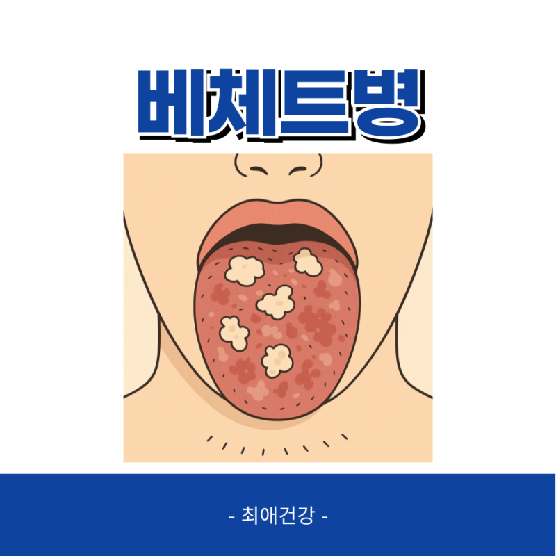 베체트병 원인 증상 치료