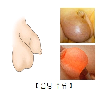 비뇨생식기 질환의 증상 네번째 통증 없는 음낭 종괴 음낭수종