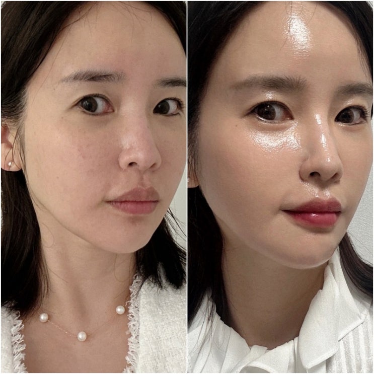 부산기미제거 잘하는 센텀피부관리 한의원 후기 부산기미제거 잘하는 센텀피부관리 한의원 후기