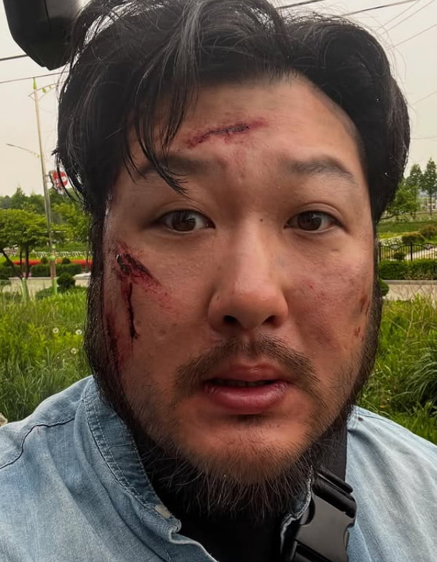  연극배우 김대호, 말라리아 감염으로 건강 위기…40도 고열에 신장 손상까지