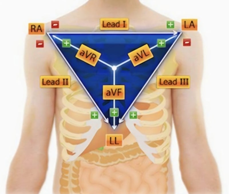 [간호] 12-lead EKG(원리, 방향, 그래프, 부착위치) : 네이버 블로그