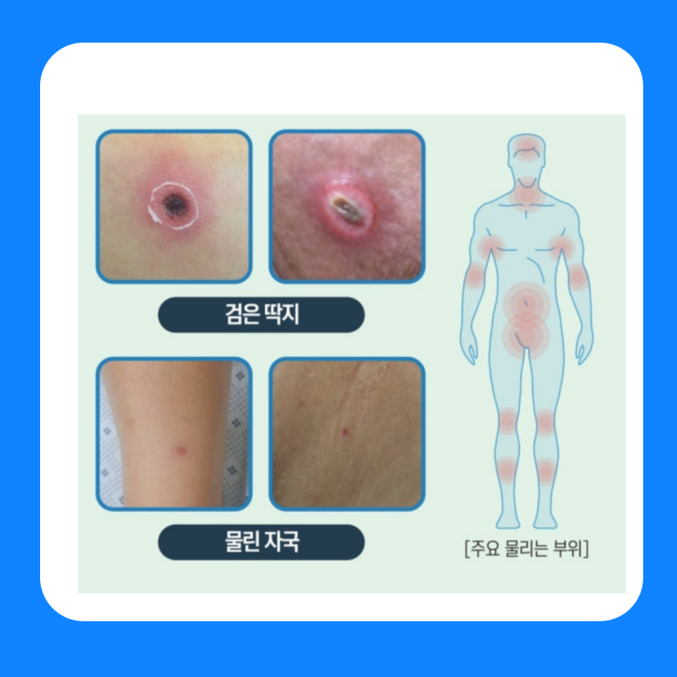  진드기 물린자국 증상 치료 가려움 연고 수포 물집 딱지