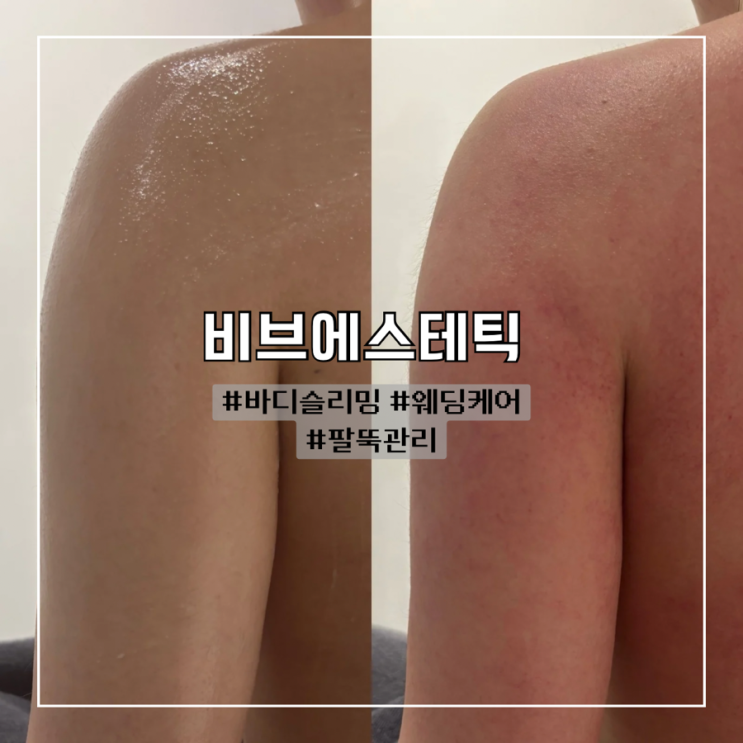  광주 상무지구 신부관리 팔뚝관리 1회차 후기 :: 비브에스테틱