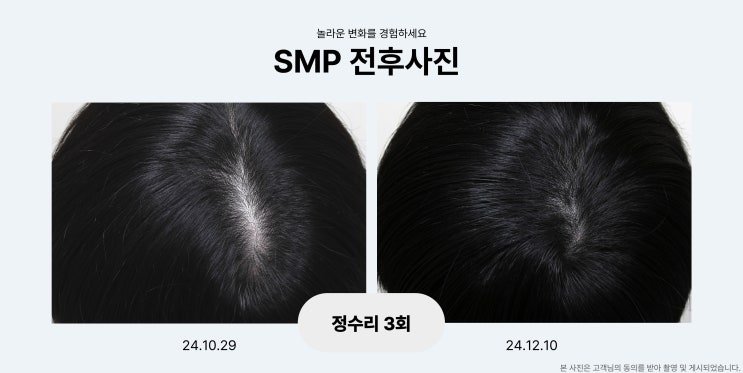  김포두피문신 M자 정수리 헤어라인 탈모커버 잘하는 곳 찾는다면?