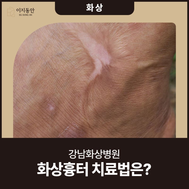 강남화상병원 화상흉터 치료법은?