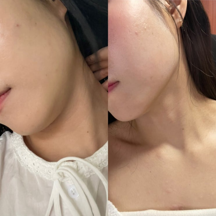  바노바기창원 리프테라2+슈링크 후기:붓기 및 통증 정리