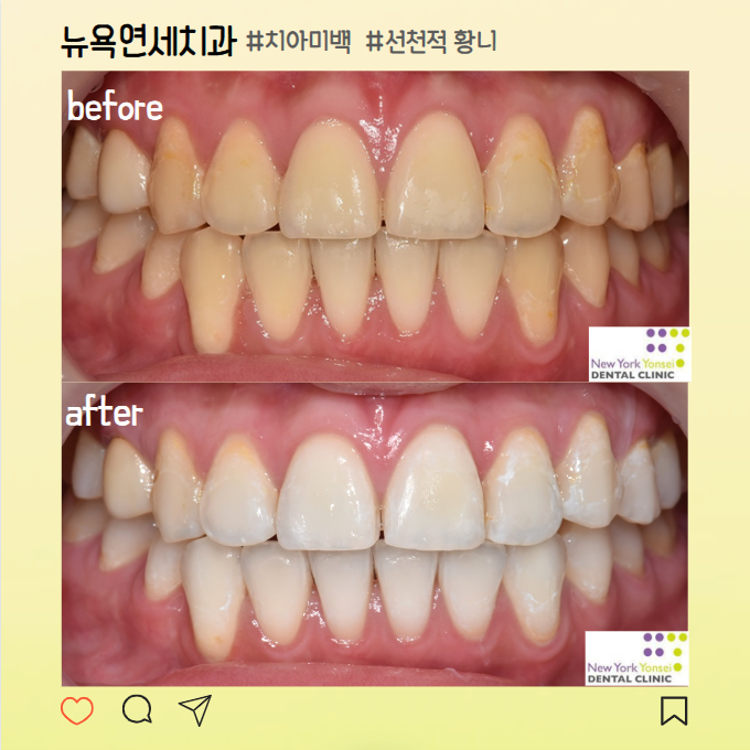  강남역치과 선천적 누런 황니 치아미백 후기 전후