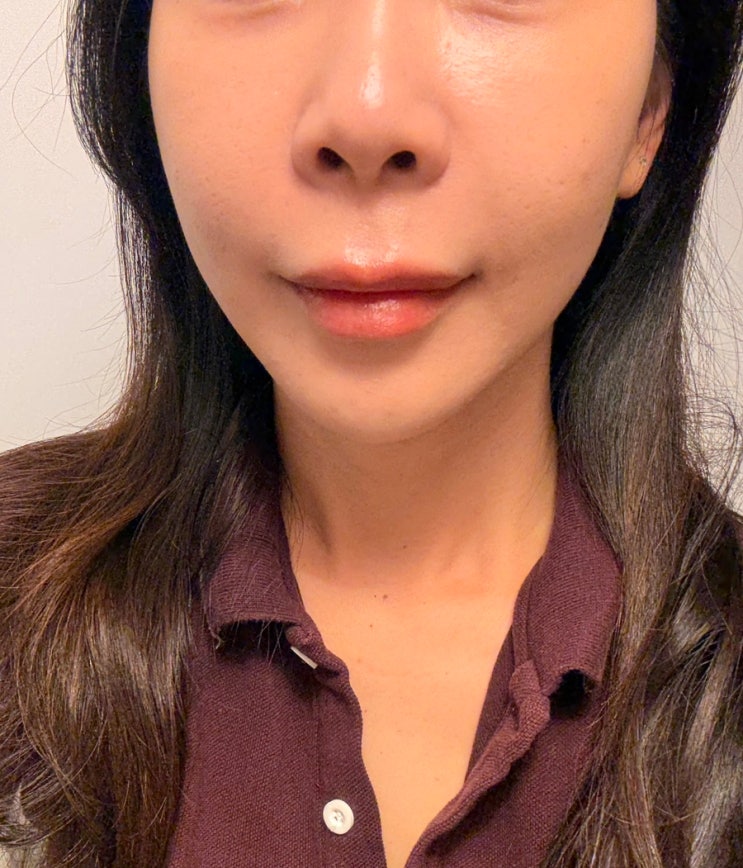  청량리피부과 팔자주름 앞볼 옆볼 쥬베룩볼륨 일주일 차 솔직후기
