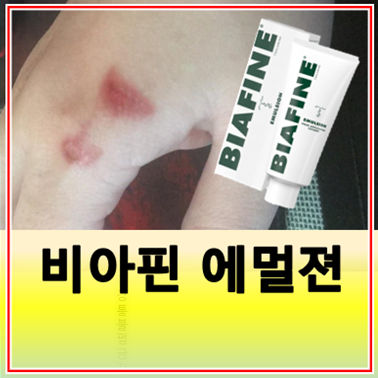 비아핀 에멀젼 화상연고 여드름 흉터 가격 효과 사용법