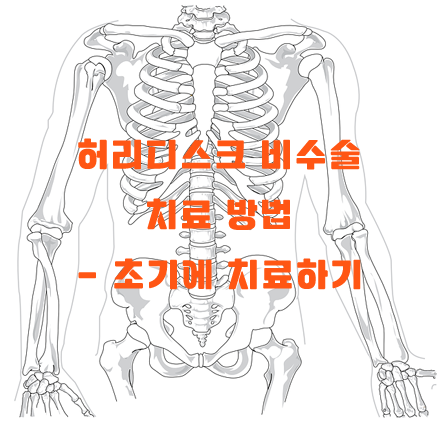 허리디스크 비수술 치료 방법 - 초기에 치료하기