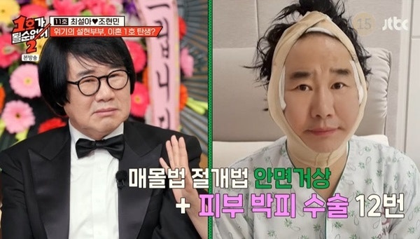 팽현숙 최양락 성형수술 조종 눈 2번 안면거상 박피 12번