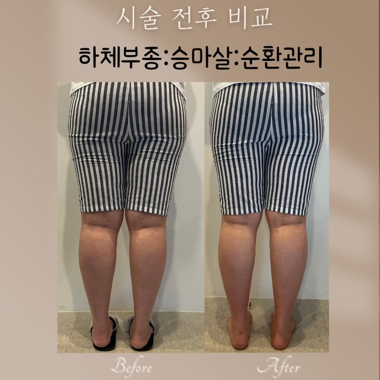  보기 싫은 승마살, 하체부종까지… 관리 전/후 사진 비교!