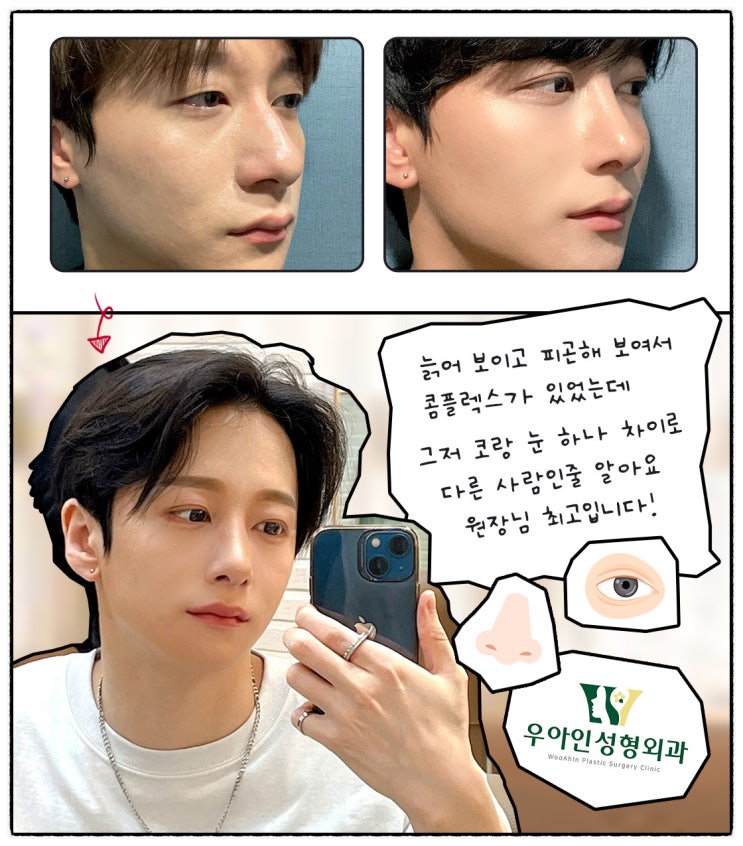 매부리코 뜻과 특징 정리