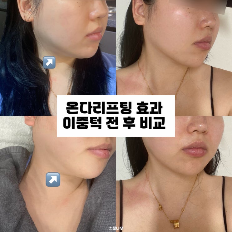  신논현역 피부과 추천 온다리프팅 6만줄 이중턱 효과 7일차 전 후 비교 후기
