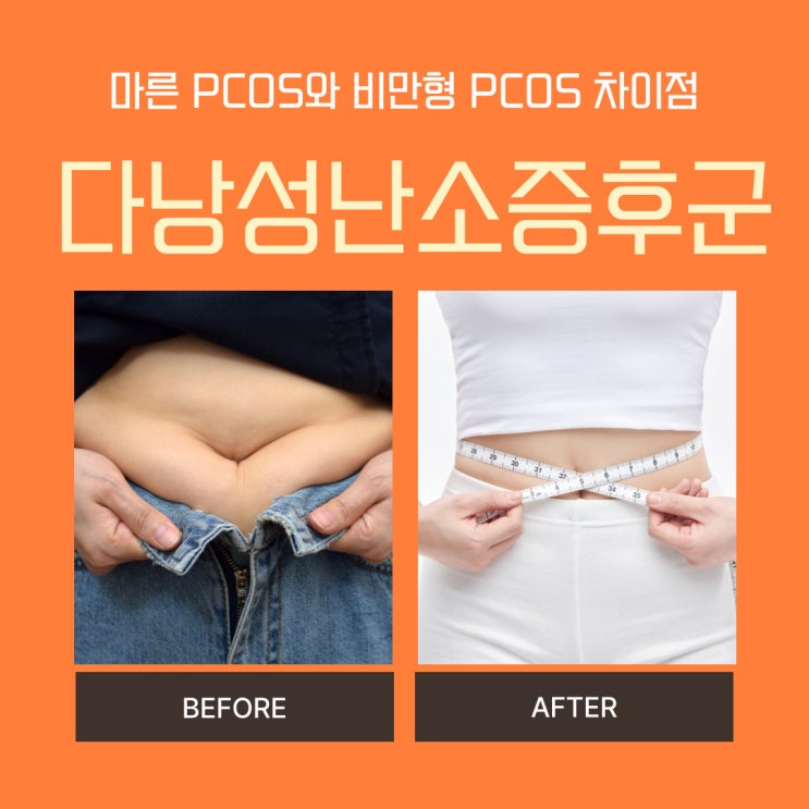  다낭성난소증후군 비만 인슐린 저항성 특징