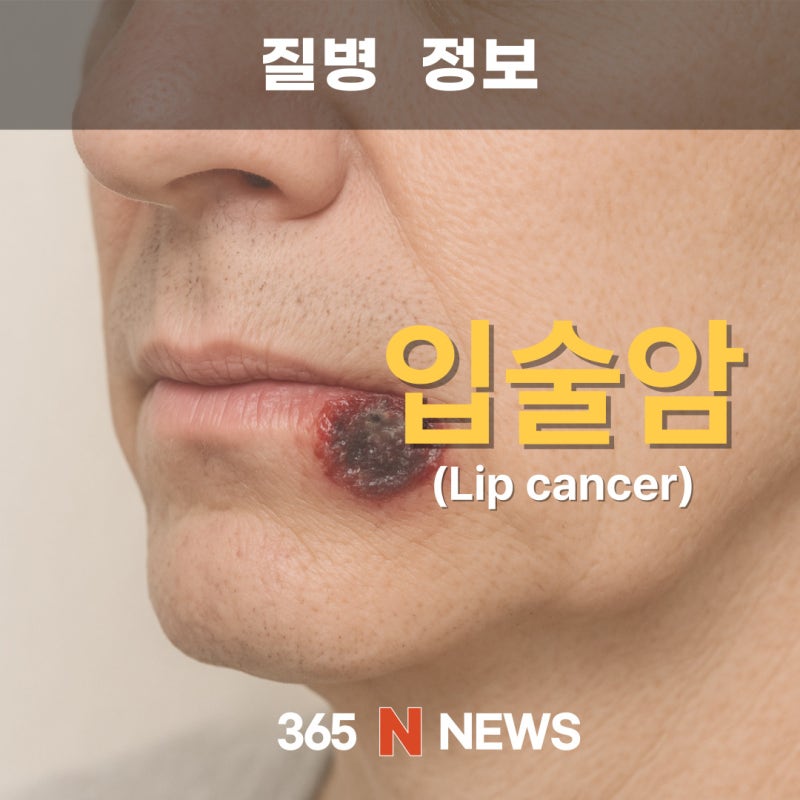 입술암_ 자외선이 부른 침묵의 침입자
