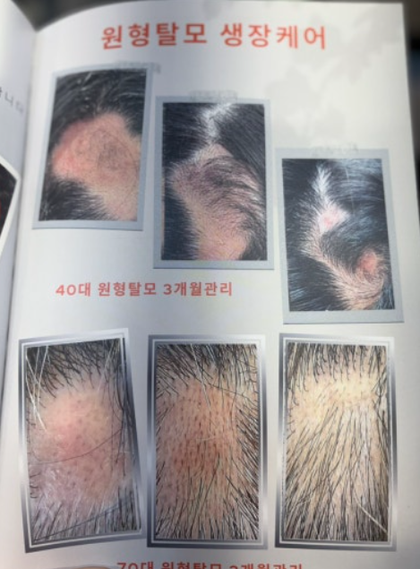  [수원] 모백(mo100)생장술 후기. 탈모 걱정 덜어준 신세계 두피케어!