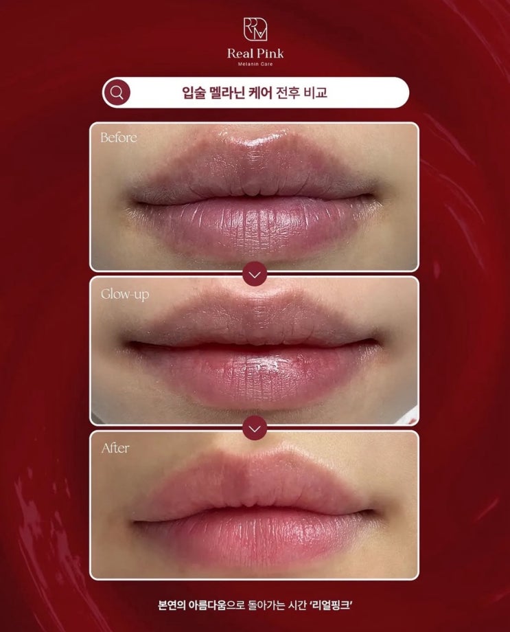  입술 멜라닌 케어 후기 1회 시술로 립스틱 필요없는 핑크빛 입술 만들기 대구아미뷰티