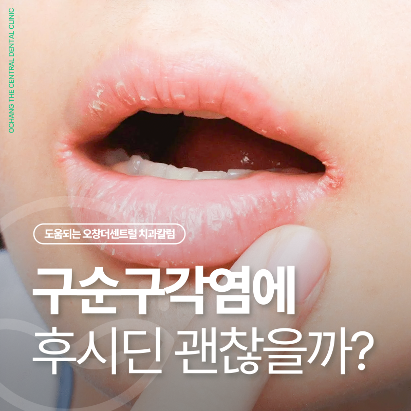 구순구각염 연고로 후시딘? 전염 걱정된다면