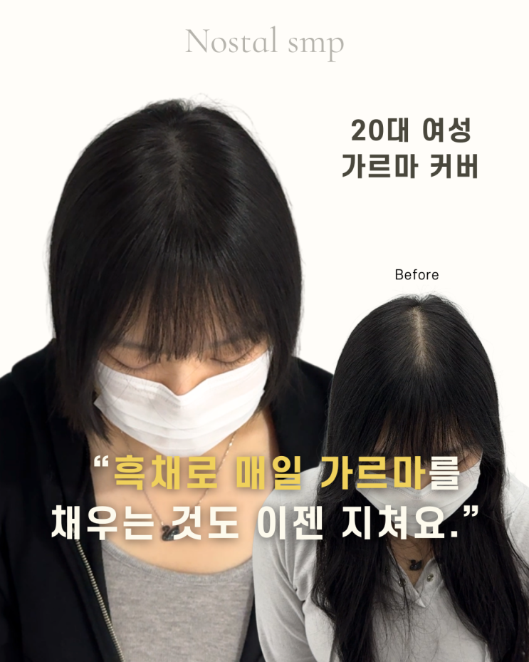  대전서구두피문신, 가르마 탈모 고민 두피문신으로 해결