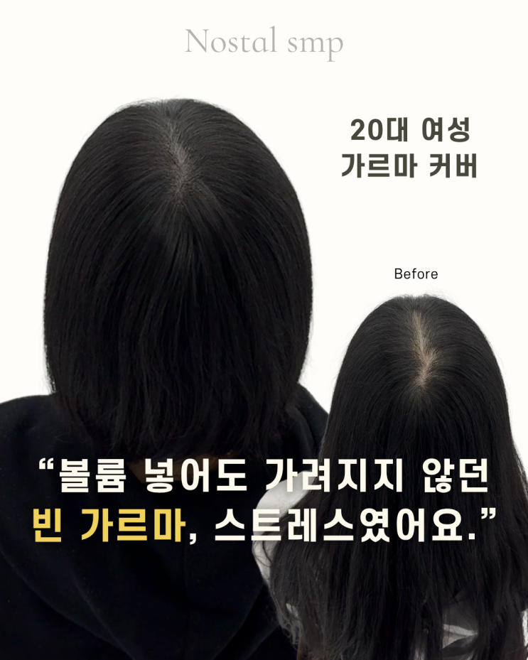  두피문신가격, 왜 이렇게 비쌀까?