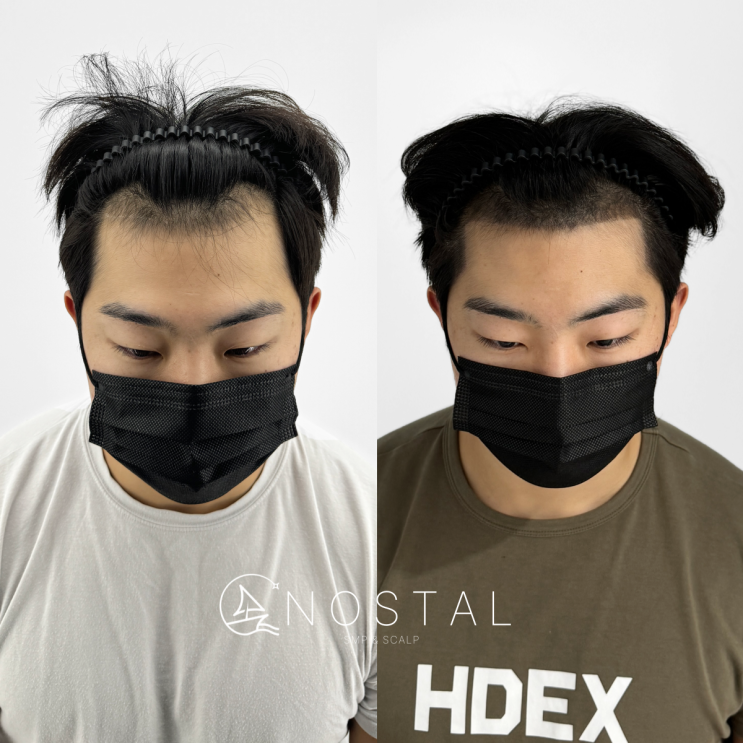  대전세종두피문신가격, 비싸다고요?