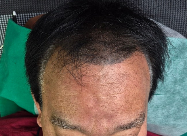  여자 남자 정수리 탈모 전주두피문신 SMP 효과 있을까?