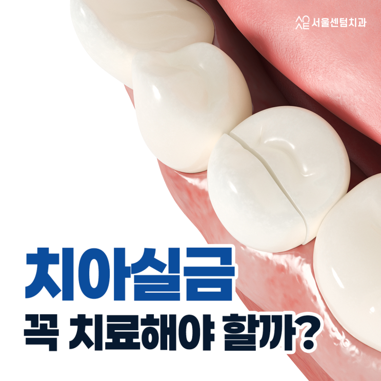  치아실금 신경쓰인다면 이것 체크하세요
