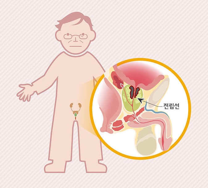  [전립선암] 한국인에게 흔한 암 인포그래픽