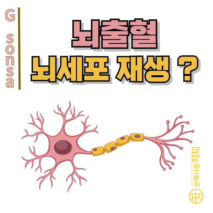  뇌출혈 – 한 번 죽은 뇌세포는 돌아올 수 없을까? - [의학정보, AlDa]