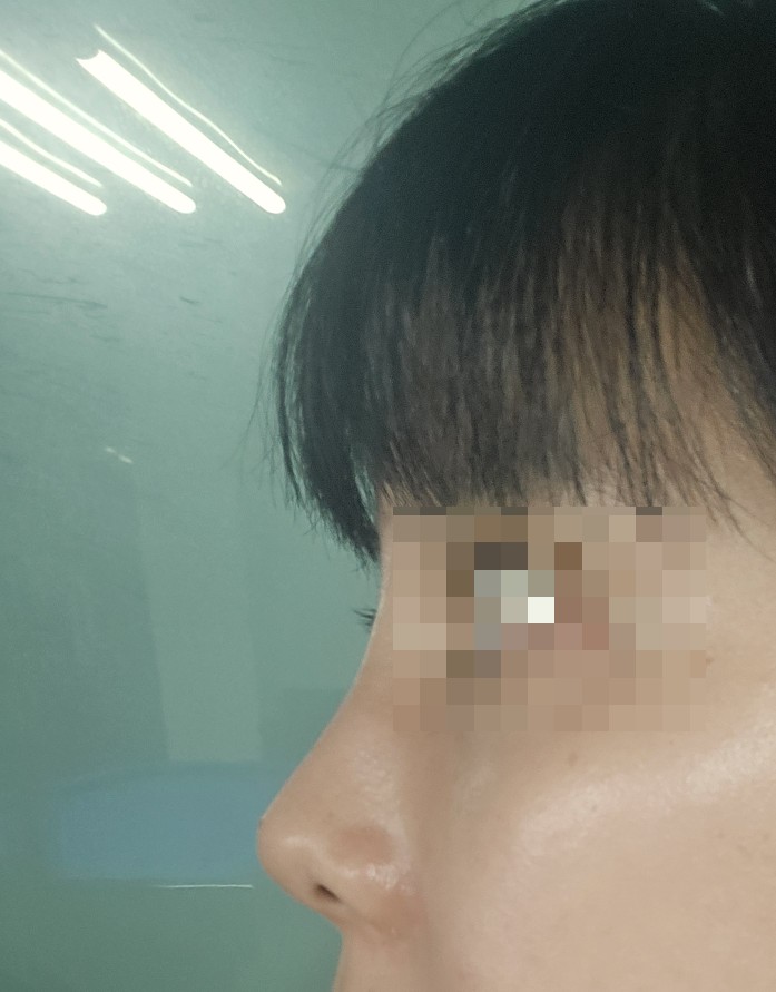  [교대역 피부과]에서 뭉뚝한 코끝 퍼진콧볼 때문에 코조각주사 +콧볼보톡스 내돈내산