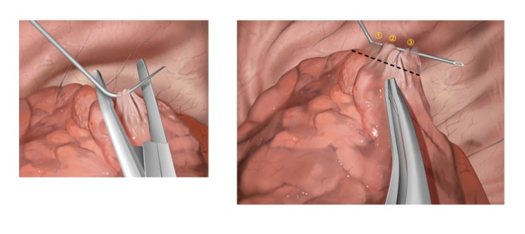  [Medical Illustration] 결찰 및 봉합술의 실제: Step by Step 메디컬 일러스트
