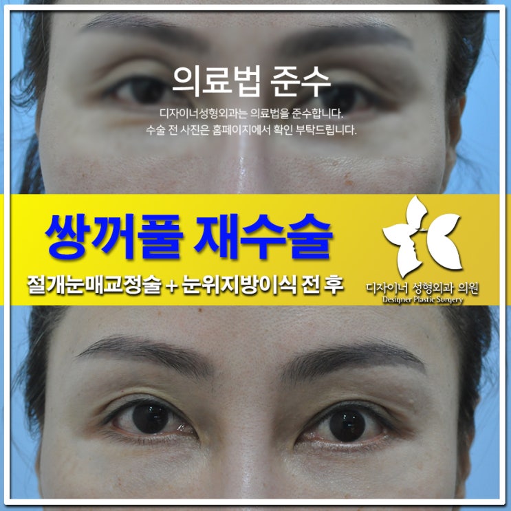  쌍꺼풀 재수술, 후회 없는 선택을 위한 모든 것