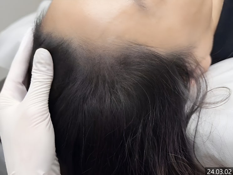  화곡두피문신 후기, 머리숱이 없어 고민이라면? 탈모치료보다 빠른 방법